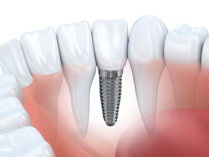 Do Dental Implants Last Forever?